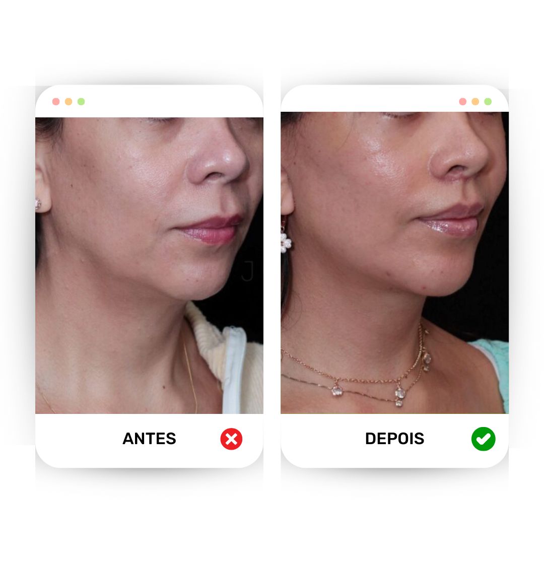 Lifting Face - Defina e modele o seu rosto!